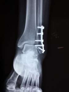 Image used under a Collective Commons License from https://www.pexels.com/photo/accident-ankle-bone-broken-415823/